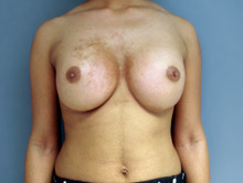 XL Breast Augmentation 600cc MPP SIlicone