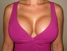XL Breast Augmentation 1000cc Saline