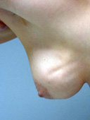 Example of breast implant rippling