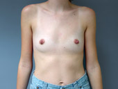 Breast Augmentation: Submuscular Placement Pre-Op