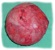 Example of breast implant capsular contracture