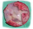Breast implant capsular contracture