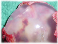 Breast implant capsule