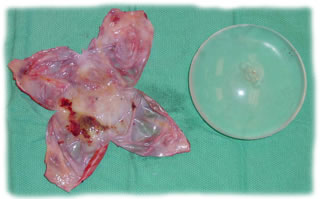 Capsule fully opened with breast implant removed